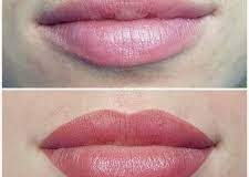Remboursement d’un soin esthétique de pigmentation des lèvres
